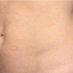 TruSculpt ID Before & After Patient #1563